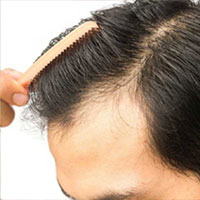 Hair Transplant