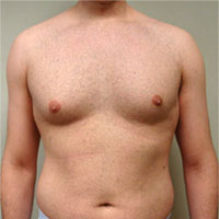 Male Breast Reduction